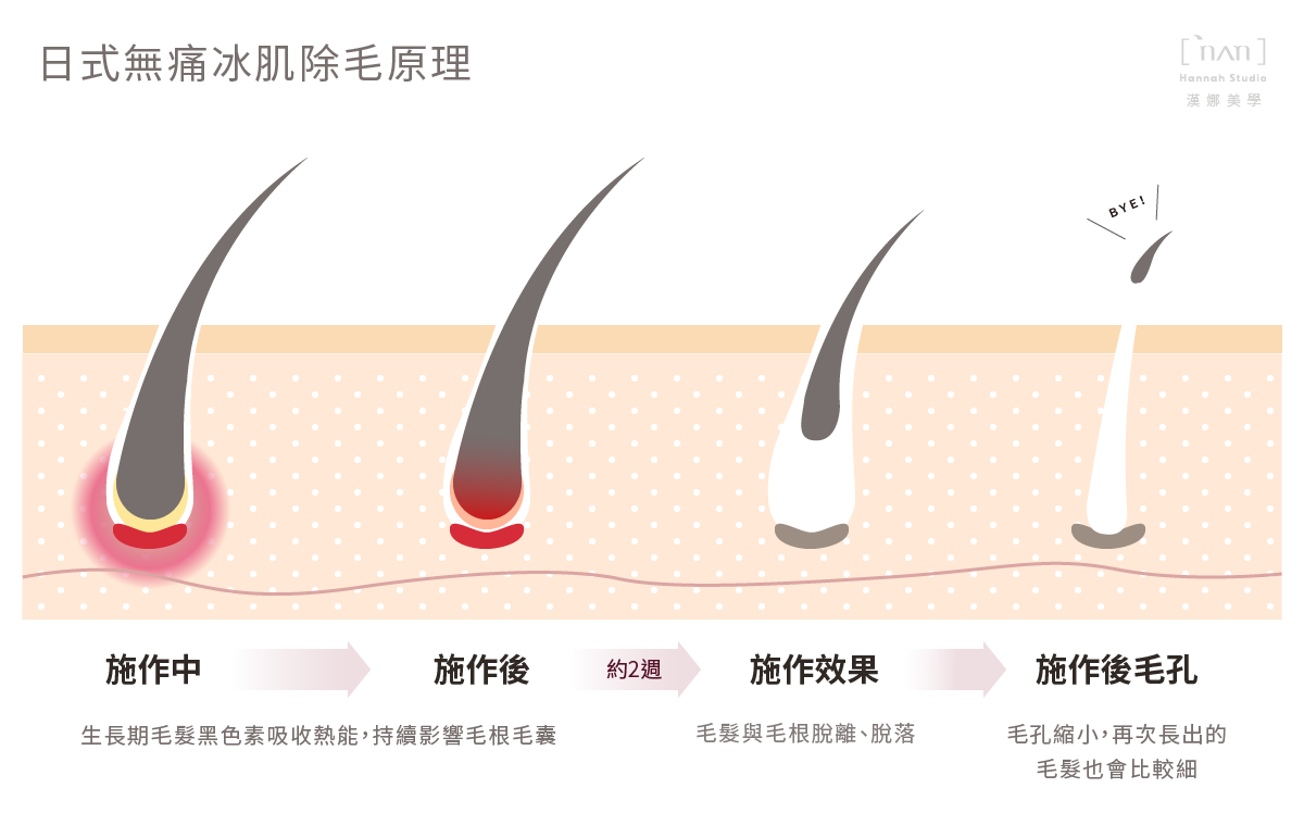 日式無痛冰肌除毛原理